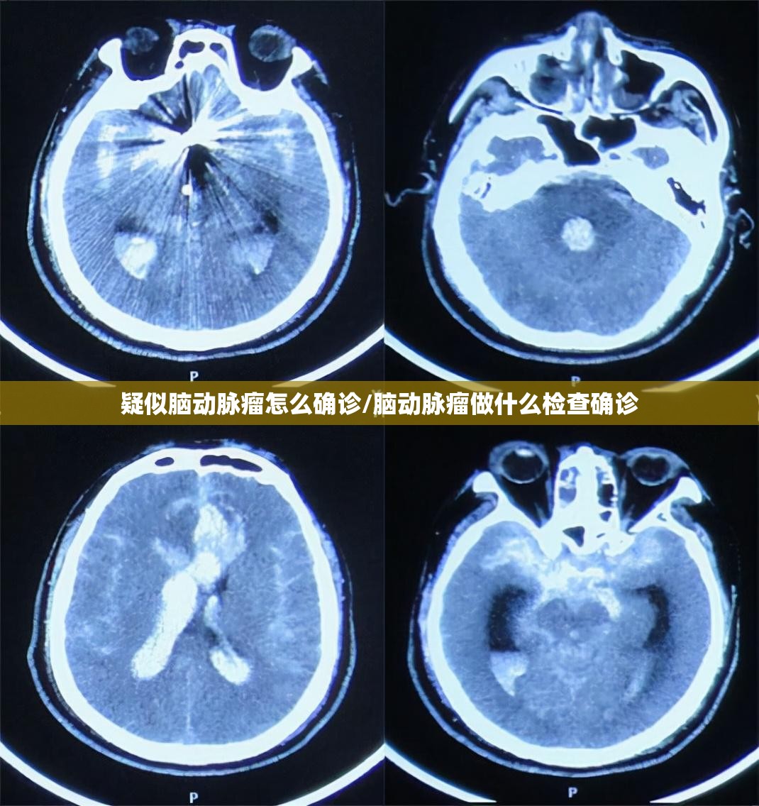 疑似脑动脉瘤怎么确诊/脑动脉瘤做什么检查确诊 疑似脑动脉瘤怎么确诊/脑动脉瘤做什么检查确诊