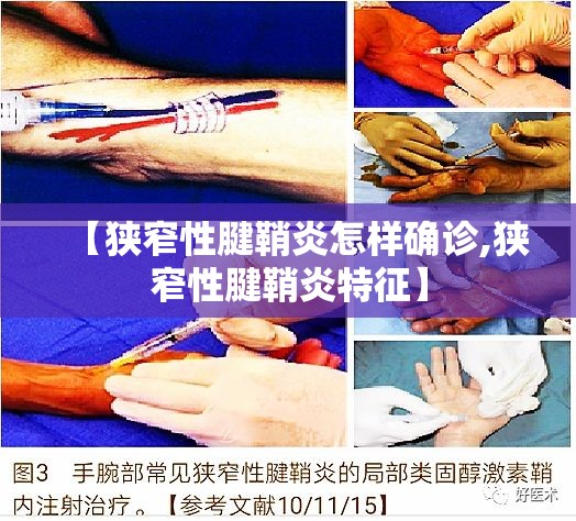 【狭窄性腱鞘炎怎样确诊,狭窄性腱鞘炎特征】 【狭窄性腱鞘炎怎样确诊,狭窄性腱鞘炎特征】