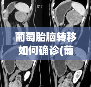 葡萄胎脑转移如何确诊(葡萄胎转移肺是子宫癌吗)