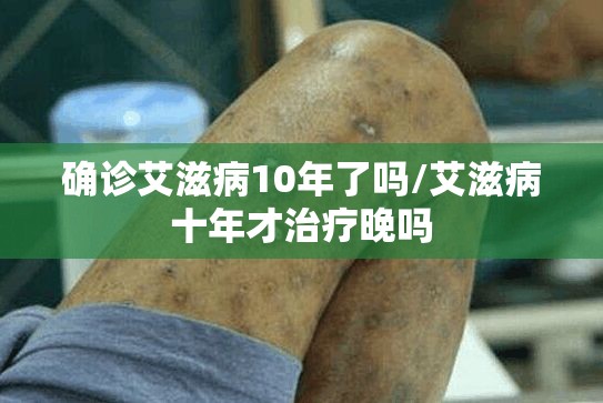确诊艾滋病10年了吗/艾滋病十年才治疗晚吗