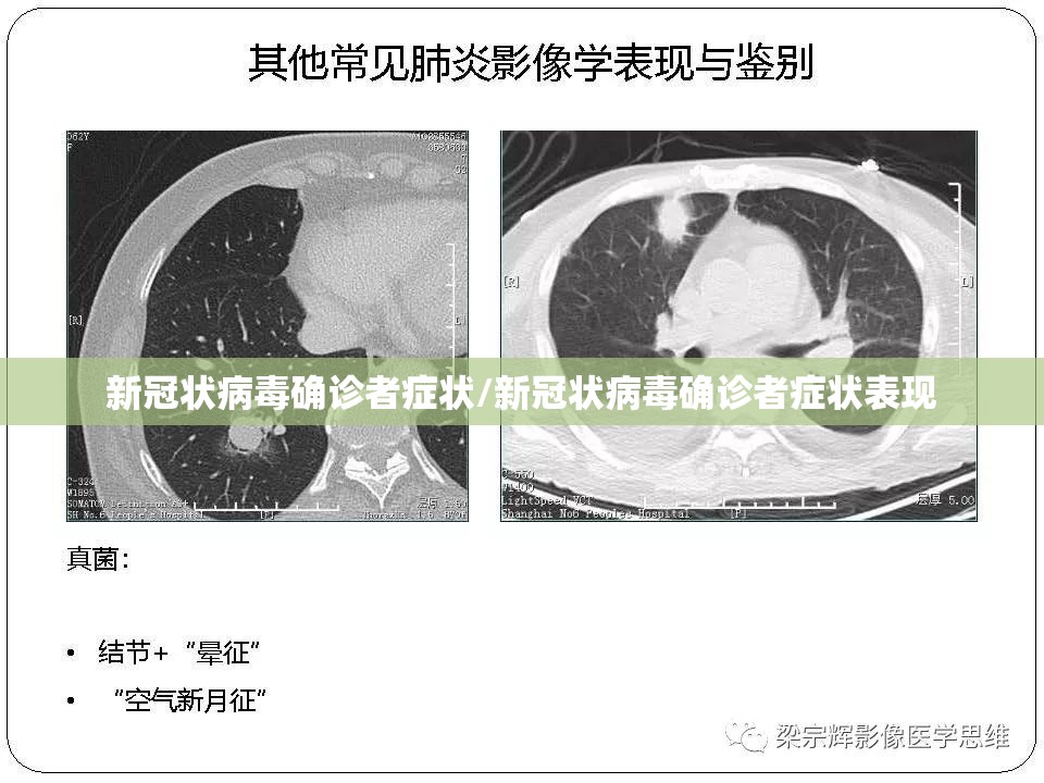 新冠状病毒确诊者症状/新冠状病毒确诊者症状表现 新冠状病毒确诊者症状/新冠状病毒确诊者症状表现