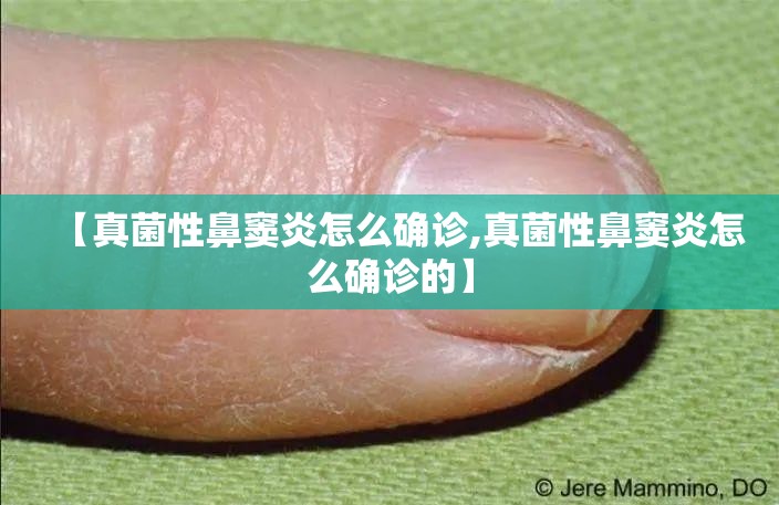 【真菌性鼻窦炎怎么确诊,真菌性鼻窦炎怎么确诊的】 【真菌性鼻窦炎怎么确诊,真菌性鼻窦炎怎么确诊的】