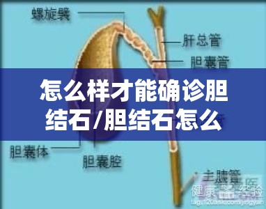 怎么样才能确诊胆结石/胆结石怎么确诊最准确