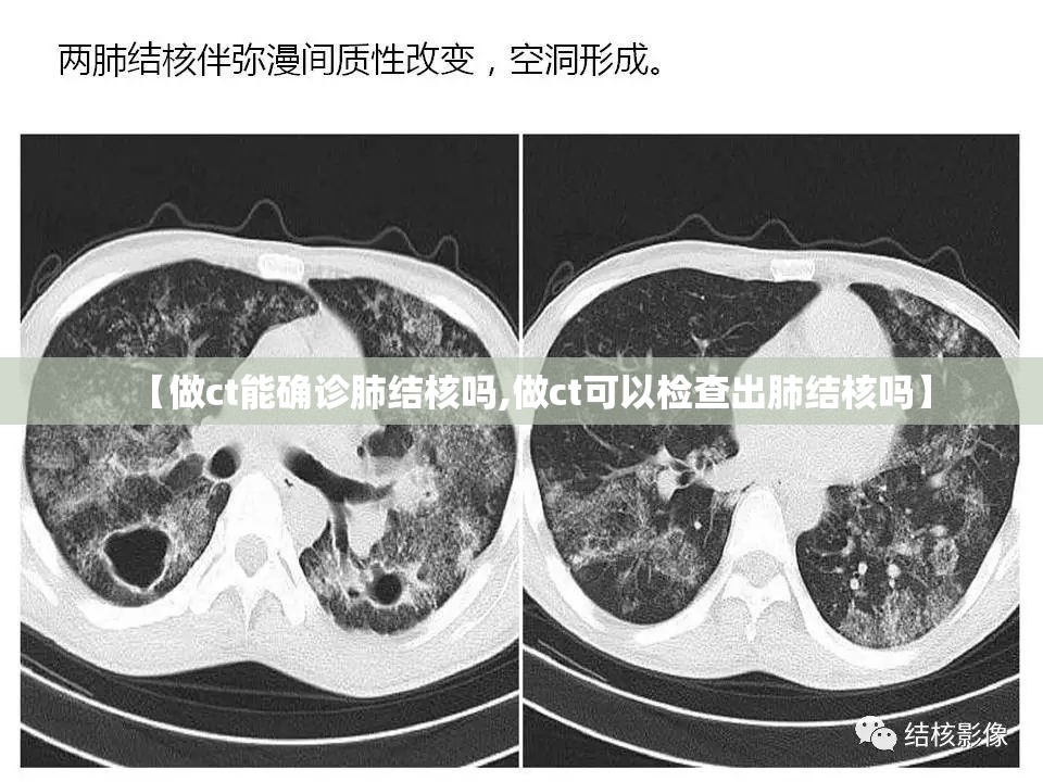 【做ct能确诊肺结核吗,做ct可以检查出肺结核吗】