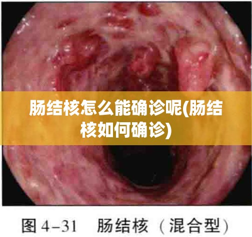 肠结核怎么能确诊呢(肠结核如何确诊) 肠结核怎么能确诊呢(肠结核如何确诊)
