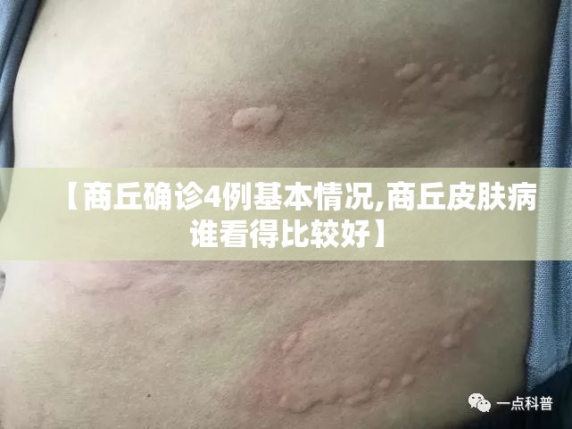 【商丘确诊4例基本情况,商丘皮肤病谁看得比较好】 【商丘确诊4例基本情况,商丘皮肤病谁看得比较好】