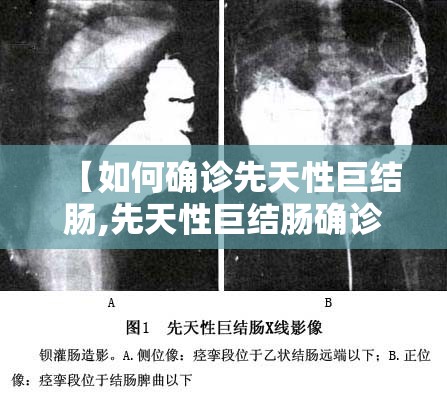 【如何确诊先天性巨结肠,先天性巨结肠确诊首选】