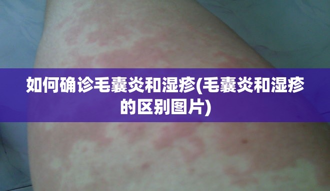 如何确诊毛囊炎和湿疹(毛囊炎和湿疹的区别图片)