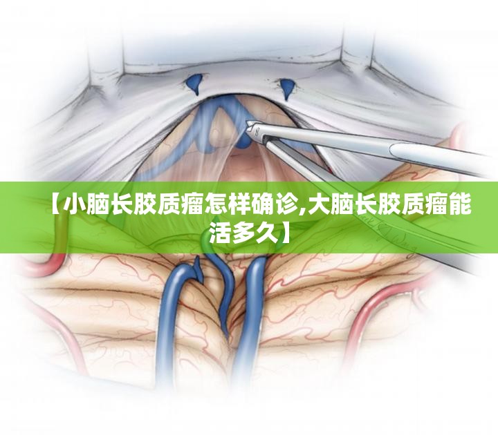 【小脑长胶质瘤怎样确诊,大脑长胶质瘤能活多久】 【小脑长胶质瘤怎样确诊,大脑长胶质瘤能活多久】