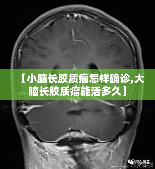 【小脑长胶质瘤怎样确诊,大脑长胶质瘤能活多久】 【小脑长胶质瘤怎样确诊,大脑长胶质瘤能活多久】