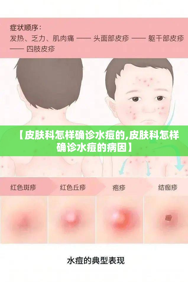 【皮肤科怎样确诊水痘的,皮肤科怎样确诊水痘的病因】