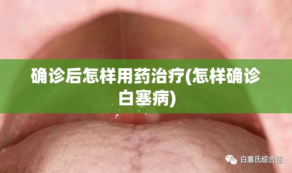 确诊后怎样用药治疗(怎样确诊白塞病) 确诊后怎样用药治疗(怎样确诊白塞病)